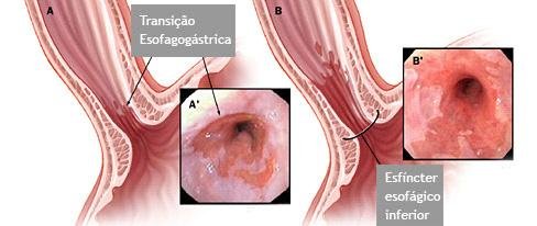 Refluxo na endoscopia